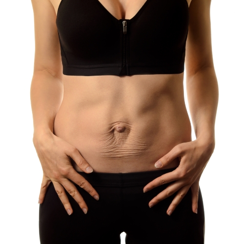 Diastasis-Recti-Smith-Physical-Therapy-&-Wellness-Taft-TX